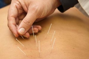 acupuntura medicinal