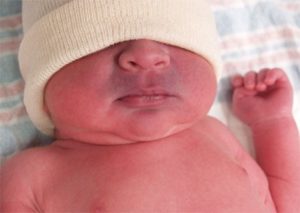 cianosis en bebé