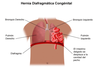 hernia diafragmatica congenita