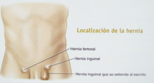 diferencia de hernia inguinal y femoral